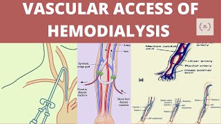 Vascular access of hemodialysis Vascular access Vascular access of dialysis AV fistula AV graft [upl. by Kcirrad]