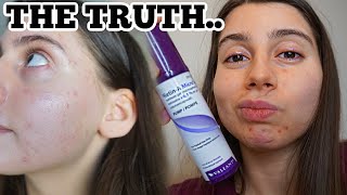 What I REALLY think of Tretinoin 2 month update [upl. by Aitan]