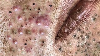 Blackheads Removal  Cystic Acne Treatment  Satisfying Blackheads Pimple popping [upl. by Jacquenetta]