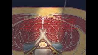 Cervical Interlaminar Epidural Injection Animation [upl. by Frannie]