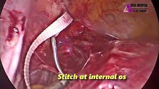 Laparoscopic Abdominal Cerclage by Dr R K Mehta  Apex Hospital Sirsa [upl. by Neeron]