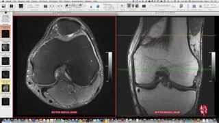 Systematic Interpretation of Knee MRI How I do it [upl. by Edrock]