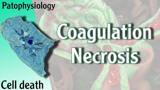 Pathophysiology  Coagulation Necrosis Hani Laith شرح [upl. by Roxanne]