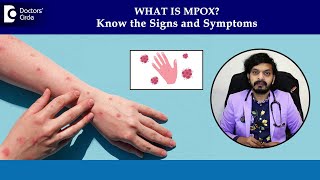 Monkeypox rash on skin  MPox Symptoms amp Diagnosis Mpox PhasesDrLeela Mohan P V RDoctors Circle [upl. by Bast]