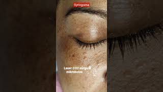 Syringoma 8 Bulan Setelah Laser CO2 Seperti Apa Syringoma BeforeAfter laserco2 [upl. by Aicirtan]