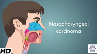 Nasopharyngeal carcinoma Causes Signs and Symptoms Diagnosis and Treatment [upl. by Hailed]