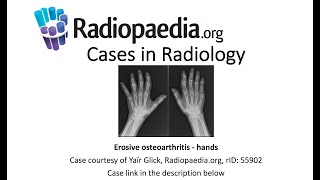 Erosive osteoarthritis Radiopaediaorg Cases in Radiology [upl. by Htilil749]