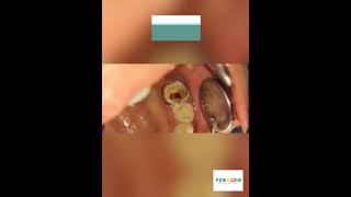 Molar Incisor hypomineralization Vital Pulp therapy Tooth Tales [upl. by Sirkin]