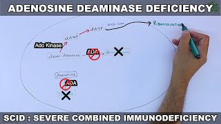 Adenosine Deaminase Deficiency  SCID [upl. by Hirasuna]