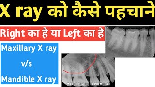 X ray को कैसे पहचाने Right का है या Left का है [upl. by Leonteen]