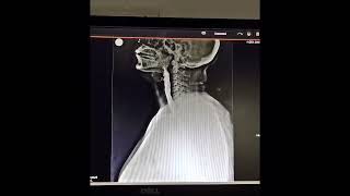 Barium swallow xray procedure [upl. by Ellynn515]