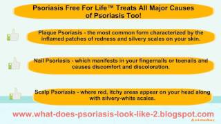 What does psoriasis look like  Psoriasis free for life review [upl. by Gauldin]