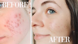 How I Cleared Up My Acne Tretinoin Doxycycline  Accutane  Big Sister Talks [upl. by Atal869]