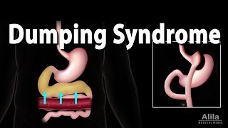 Dumping Syndrome Animation [upl. by Elatia813]