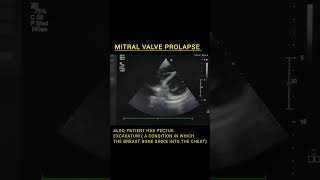 Mitral Valve Prolapse  echocardiography echo ultrasound sonography cardiology mitralvalve [upl. by Riha]