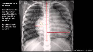 How to measure Cardiomegaly in CXR [upl. by Rahel]