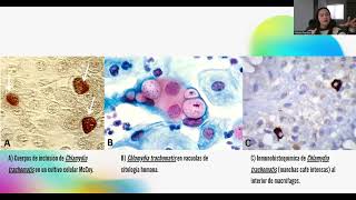 PIA Chlamydia trachomatis  Natalia Barrera [upl. by Lizzy]