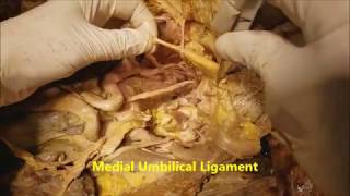 Pelvic Narrative Surgical Dissection  Iliac Artery Branches  Sanjoy Sanyal [upl. by Vite]