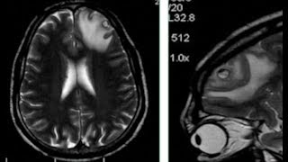 TMT NeuroRadiology CNS Infections Part II [upl. by Aikat]