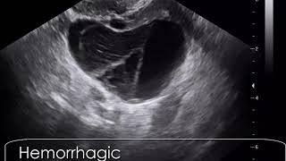 case 609 Hemorrhagic corpus luteum cyst CLC [upl. by Gish]