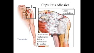 Capsulitis Adhesiva en hombro👉 Terapia  Rehabilitación [upl. by Hafeetal647]