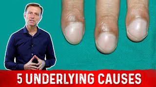 What Causes Clubbing of the Nail [upl. by Valer]