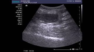 Liposarcoma of soft tissues [upl. by Leiser]