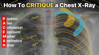 How To Critique a Chest XRay 4 DIFFERENT EXAMPLES [upl. by Aciruam802]