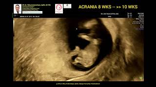 Acrania early diagnosed 8weeks  10 weeks [upl. by Onirefez]