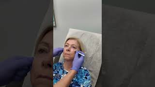 Restylane for Youthful Skin  Spyglass Dermatology [upl. by Robbi786]