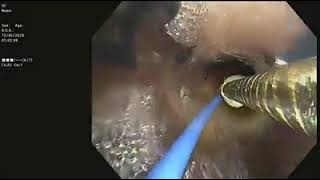 Bronchoscopic bronchopleural fistula closure  Sequential Balloon occlusion  Sphigot placement [upl. by Shiroma]