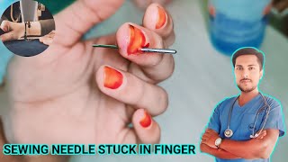 Foreign Object Removal Removing a Broken Sewing Needle from Finger alliedhealthsciencefirstaid [upl. by Lesya]