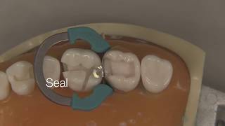 Class II Composite Restoration  Stevenson Dental Solutions [upl. by Sidnarb]