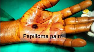 Viral Papilloma of palm Excision under anaesthesia [upl. by Myer205]