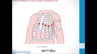 075  Cardiac Ischemia  STEMImp4 [upl. by Amilah847]