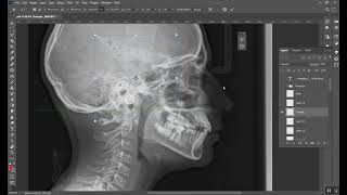 Cephalometrics Part 5 المرحلة الخامسة [upl. by Merete]