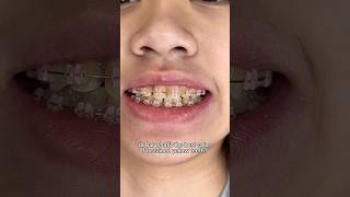 Best Braces Colors for Stained Yellow teeth [upl. by Orren]