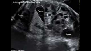 Occlusion intestinale  la dilatation des anses grêles et une hyperpéristaltisme  foetus de 34 SA [upl. by Lovmilla596]