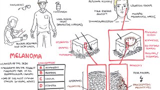 Melanoma  Overview signs and symptoms pathology risk factors treatment [upl. by Losiram355]