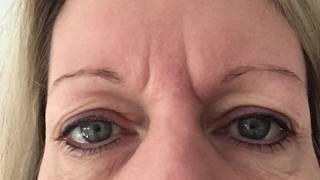 Hooded Eye Lids  Plasma Pro  Plasma Blast  Fibroblast [upl. by Anilehs]