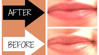 How To Fix Chapped Lips Fast [upl. by Cressy]