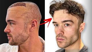 6 Month Hair Transplant Journey Full Recovery [upl. by Morlee]