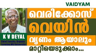 വെരിക്കോസ് വെയിൻ വൃണം ആയാലും മാറ്റിയെടുക്കാം NaturalAyurvedic Treatment Varicose Veins kvdayal [upl. by Ednalrim255]