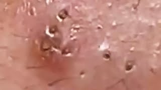 Extraction profonde des points noirs Acné kystique et popping 4 [upl. by Inad]