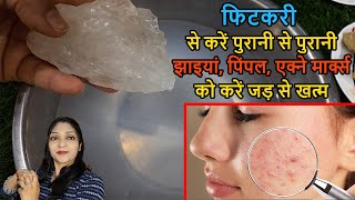 fitkari ke faydeसिर्फ 3 दिन Use कर लो Acne Pimple Tiny Bumps खत्म  How To Use fitkari on face [upl. by Desirea]