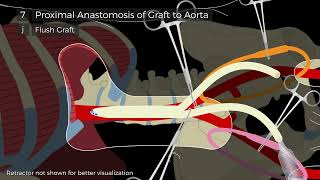 Thoracofemoral Bypass A Retroperitoneal Approach Steps [upl. by Evilo]