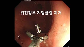 위내시경 위전정부 지혈 클립 제거 The process of removing a hemostatic clip using endoscopy [upl. by Hubble]