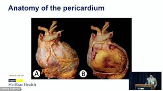 The Evolving Paradigm of Pericardial Disease navigating new frontiers with evidence [upl. by Fennelly]