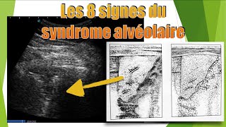 8 aspects de pneumopathie en échographie [upl. by Malony]