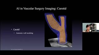 AI in Vascular Surgery [upl. by Rupert]